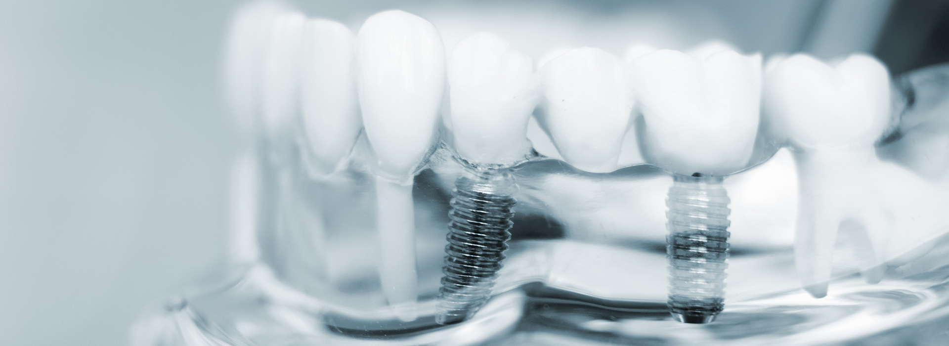 JK Dentistry | Crowns, Cosmetic Dentistry and Teeth Whitening